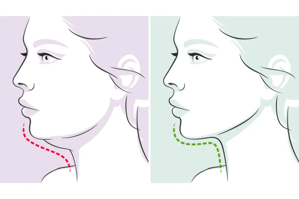 double chin removal Lahore