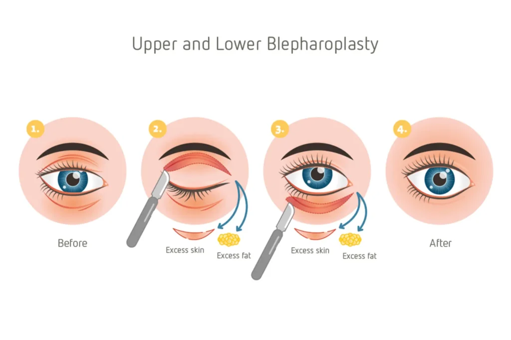 eyelid surgery in Pakistan