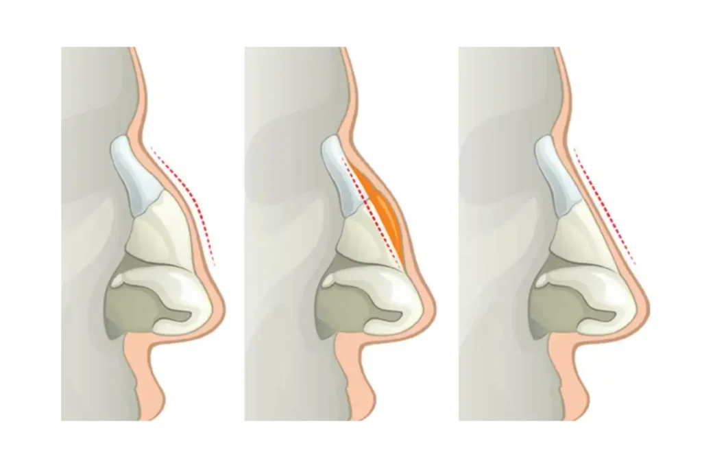 nose bone correction lahore