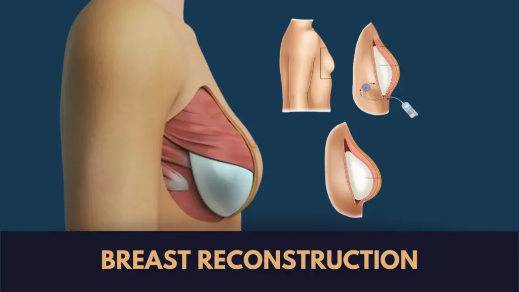 Breast Reconstruction Surgery