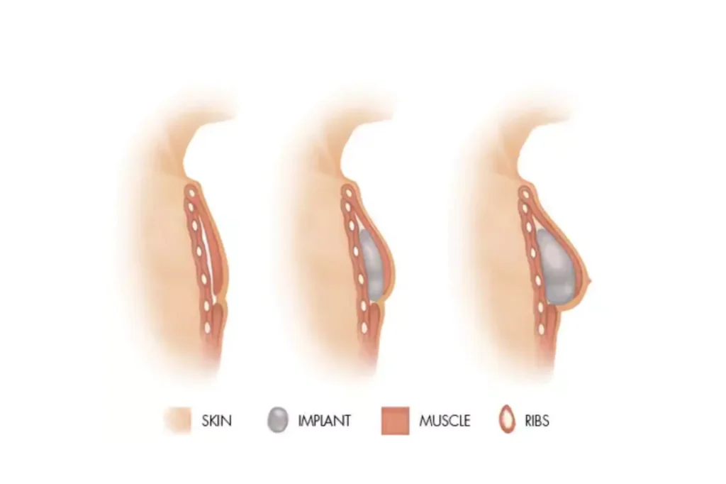 breast reconstruction Pakistan