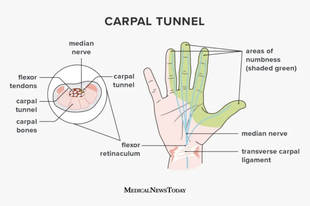 carpal tunnel treatment lahore