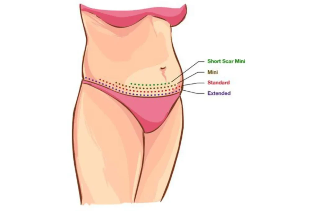 tummy tuck cost lahore