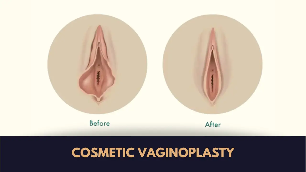 Cosmetic Vaginoplasty in Lahore