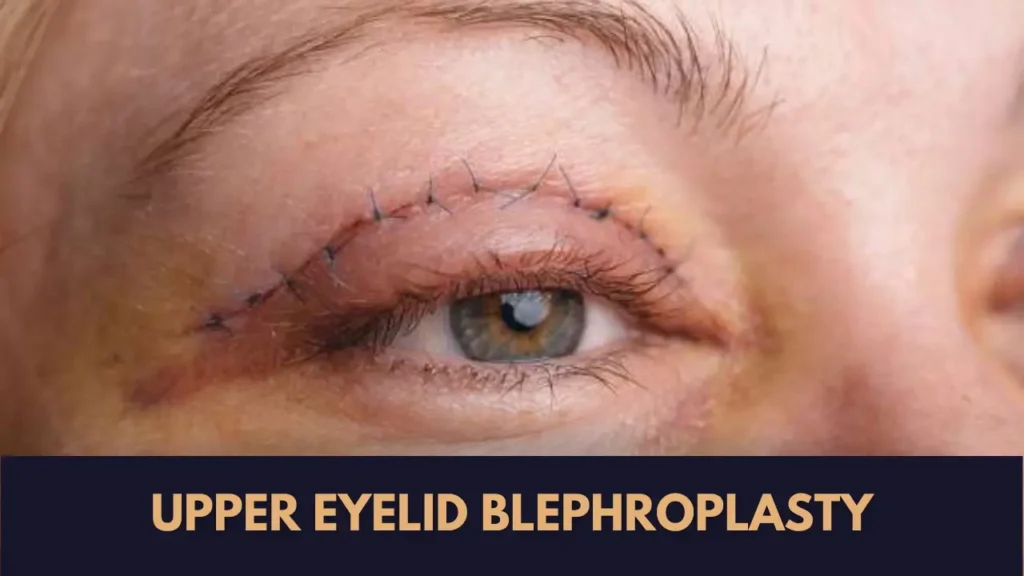 upper eyelid blephroplasty