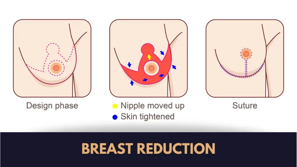 Breast Reduction Surgeon
