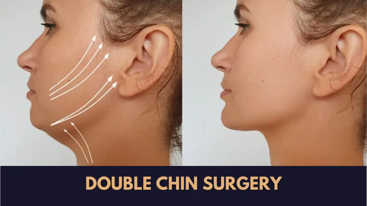 Double Chin Surgery