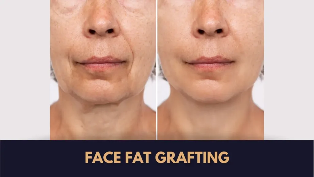 Face Fat Grafting in Lahore