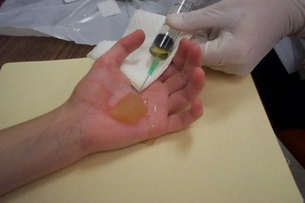 burn doctor in Lahore