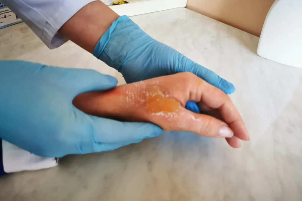 burn treatment Lahore