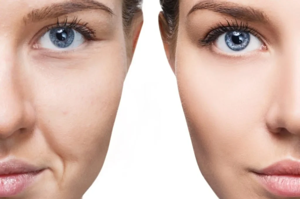 face fat transfer lahore