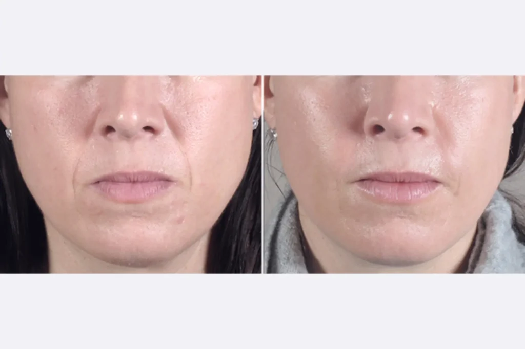 facial fat grafting lahore