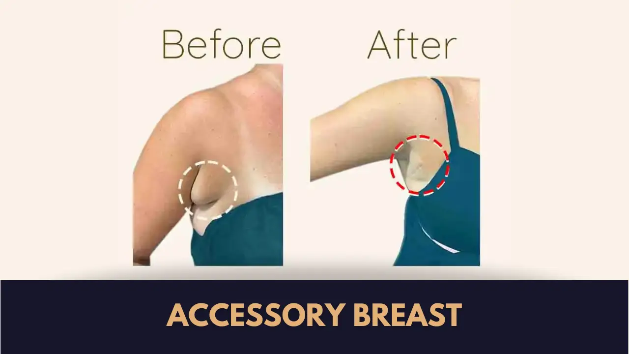 Accessory Breast Surgery