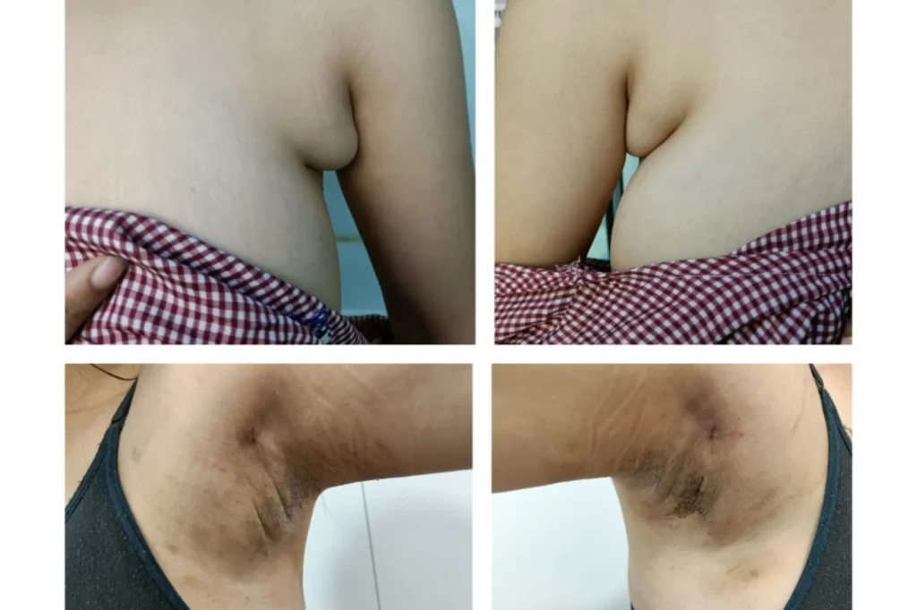 accessory breast surgery in lahore
