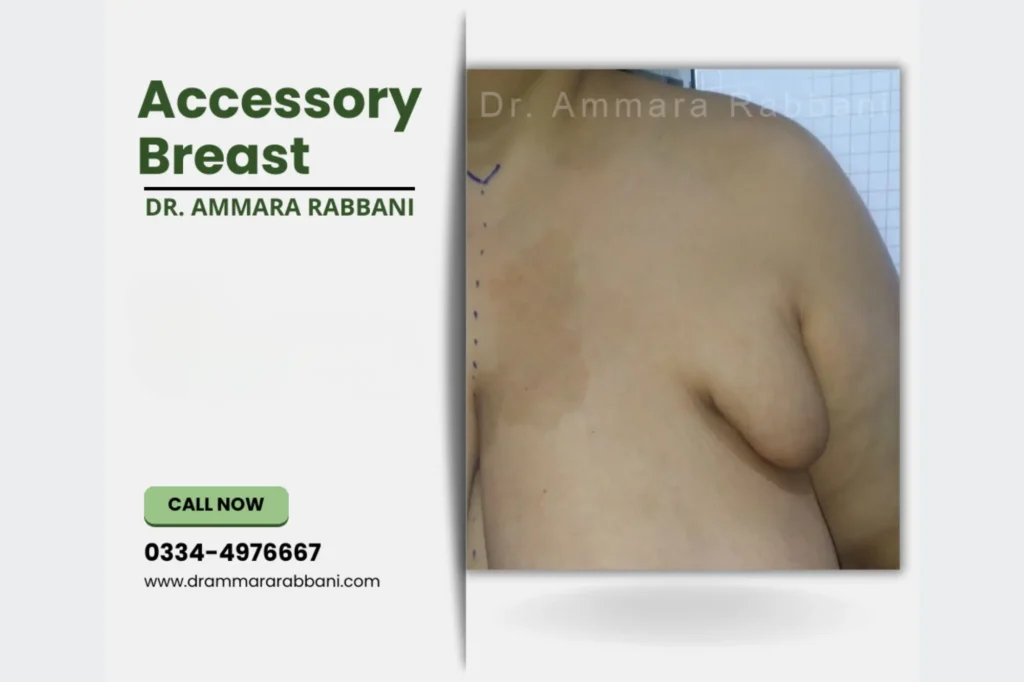 accessory breast surgery pakistan