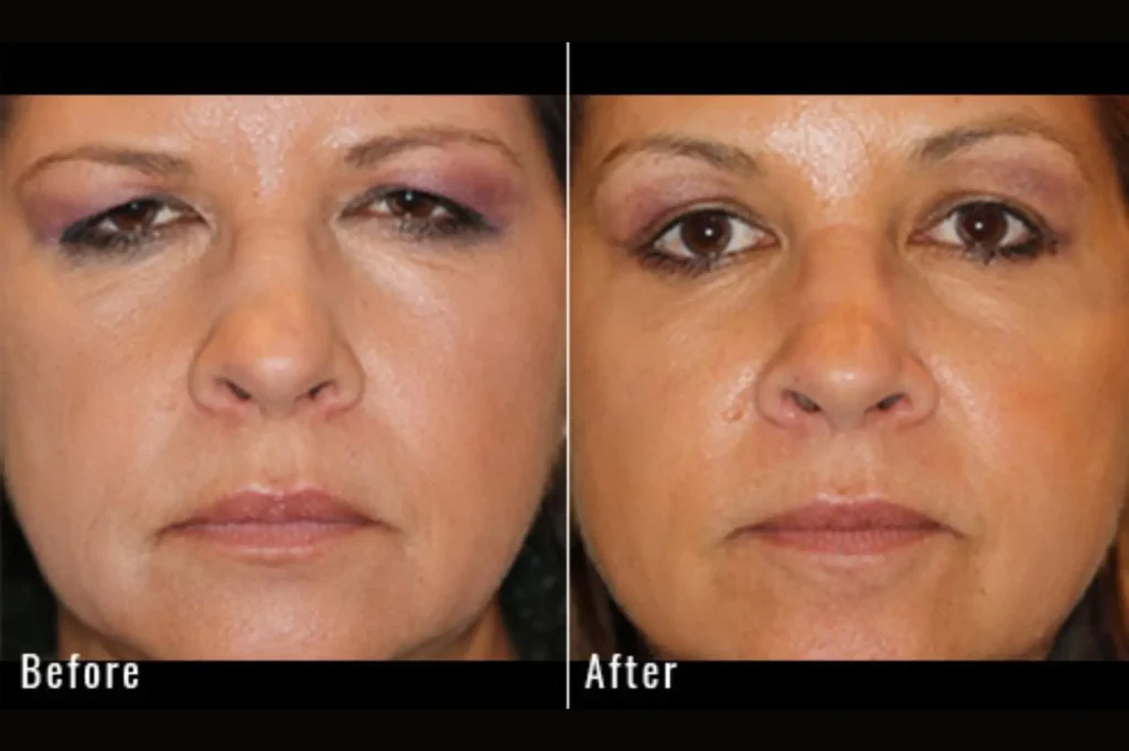 brow lift surgery in lahore