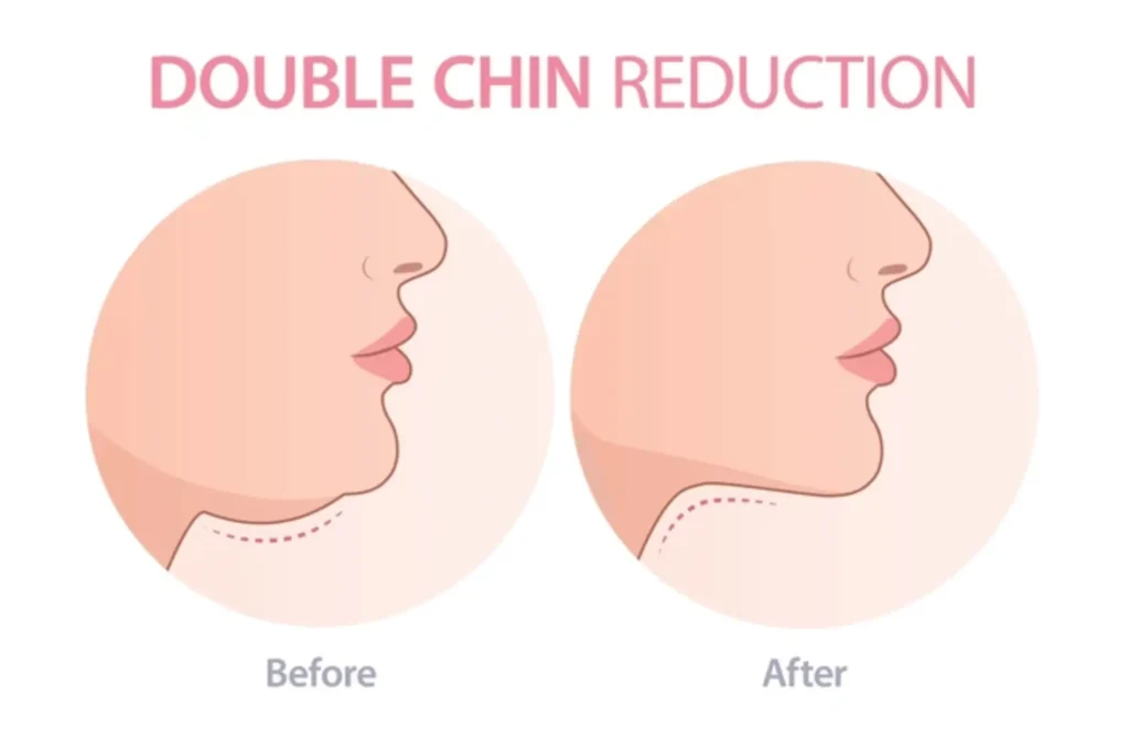 chin liposuction lahore