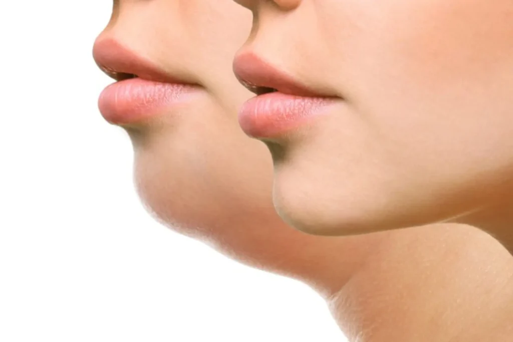 double chin removal lahore