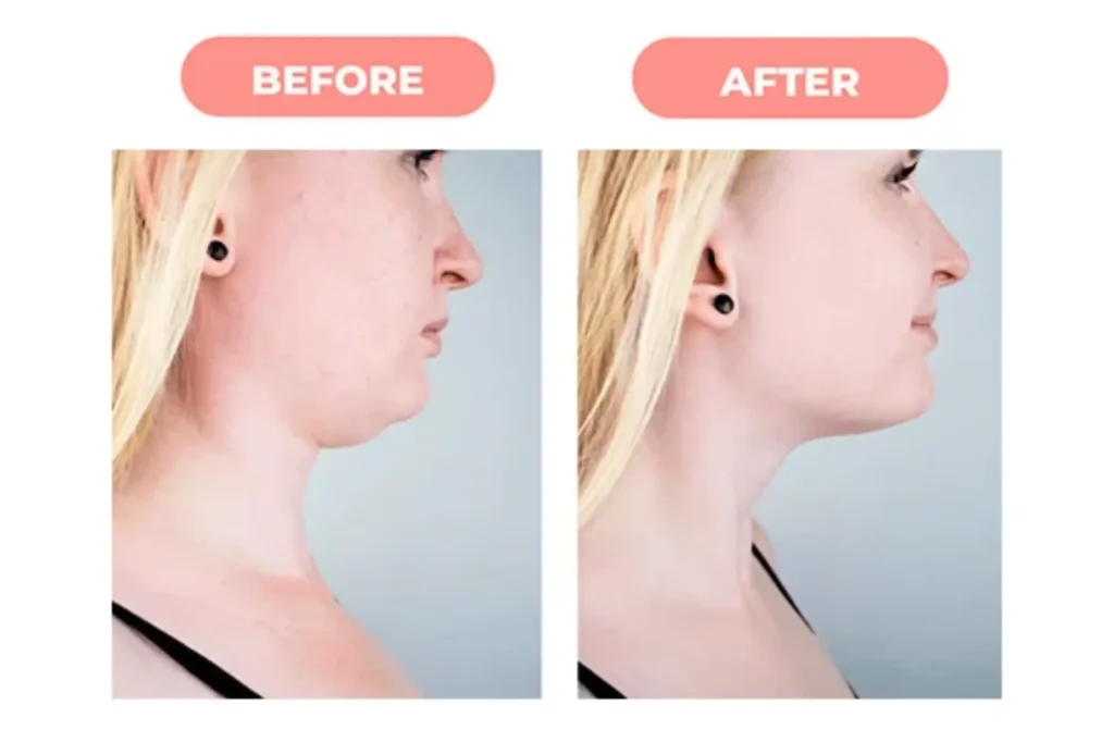 double chin surgery in lahore