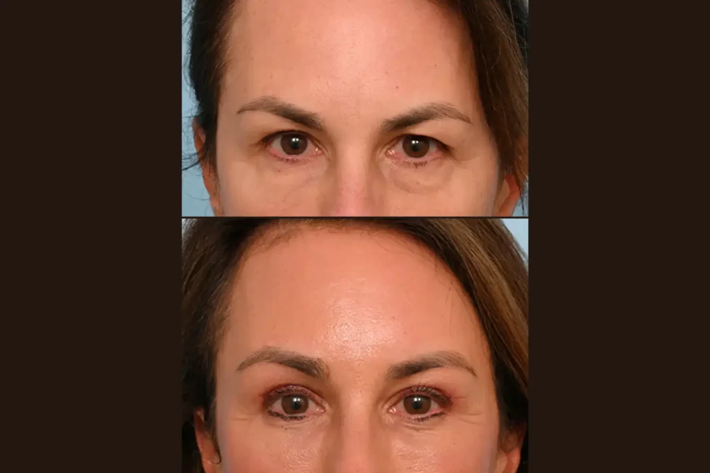 forehead lift lahore