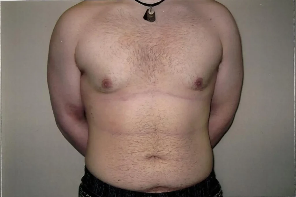 liposuction cost lahore