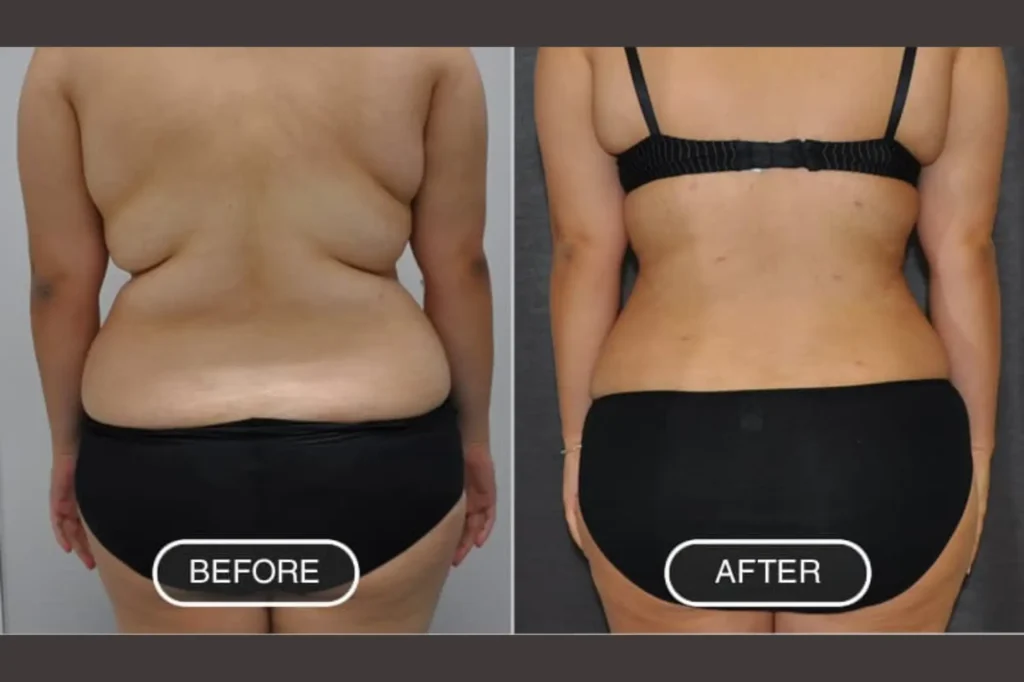 liposuction surgery cost in lahore