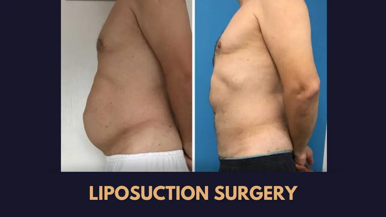 liposuction surgery cost