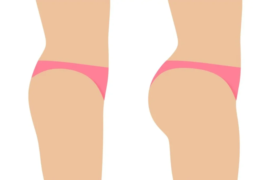 BBL vs Butt Lift