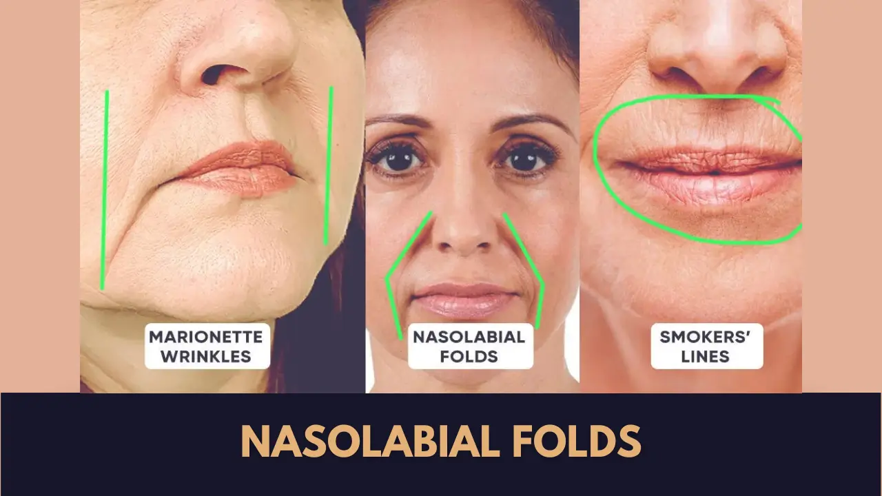 nasolabial folds