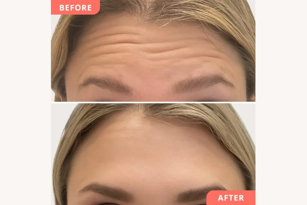 wrinkle treatment lahore