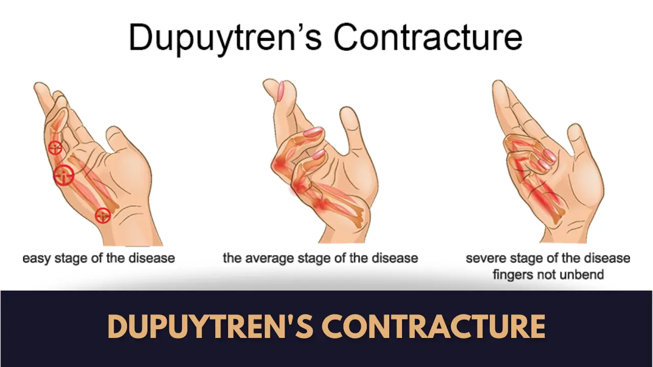 Dupuytren Contracture
