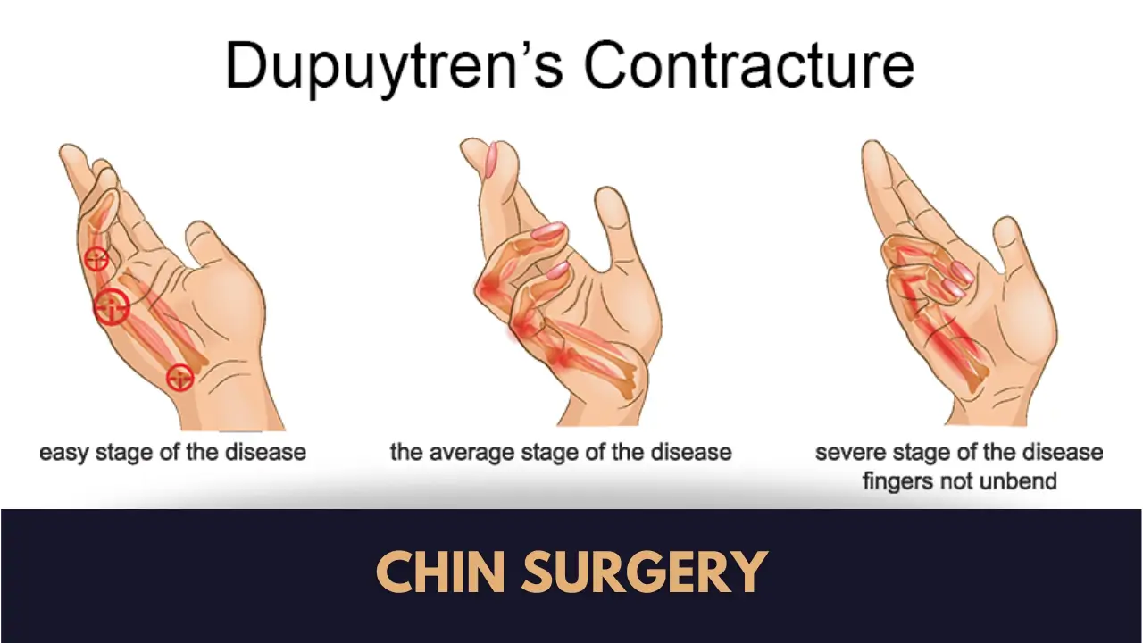 Dupuytren Contracture