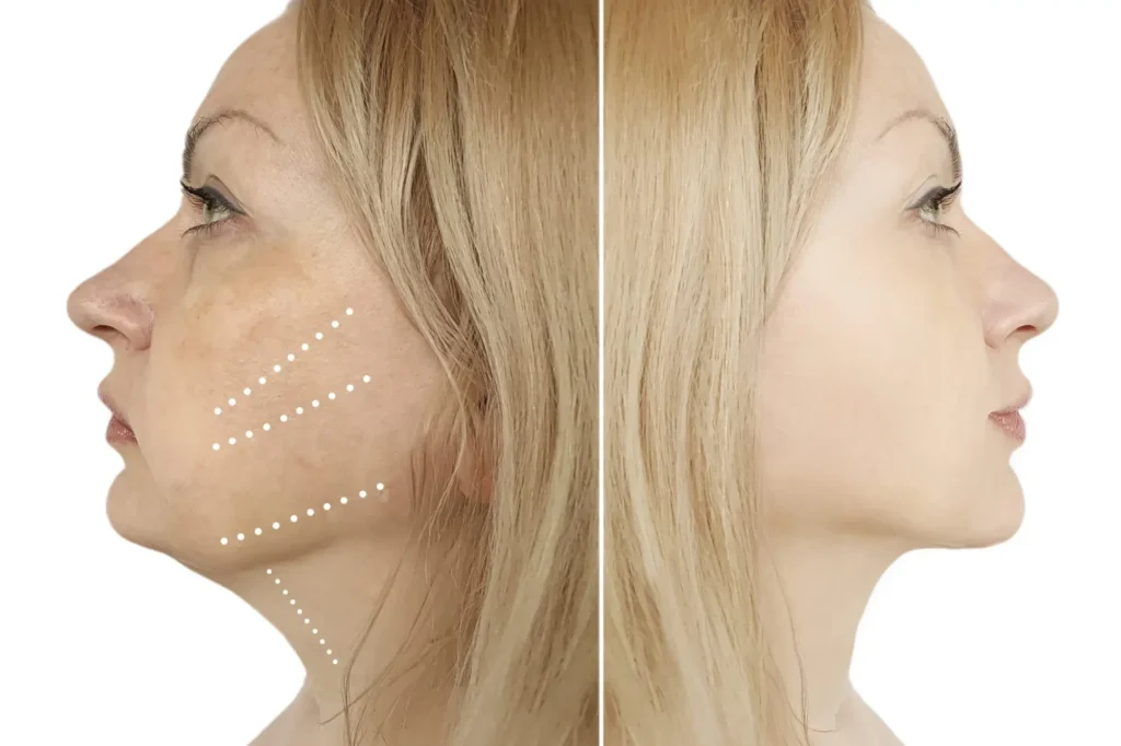 chin augmentation cost lahore