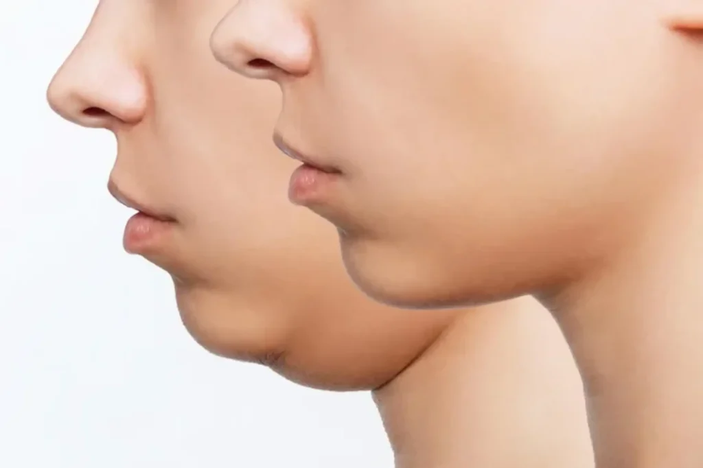 chin surgery cost in lahore