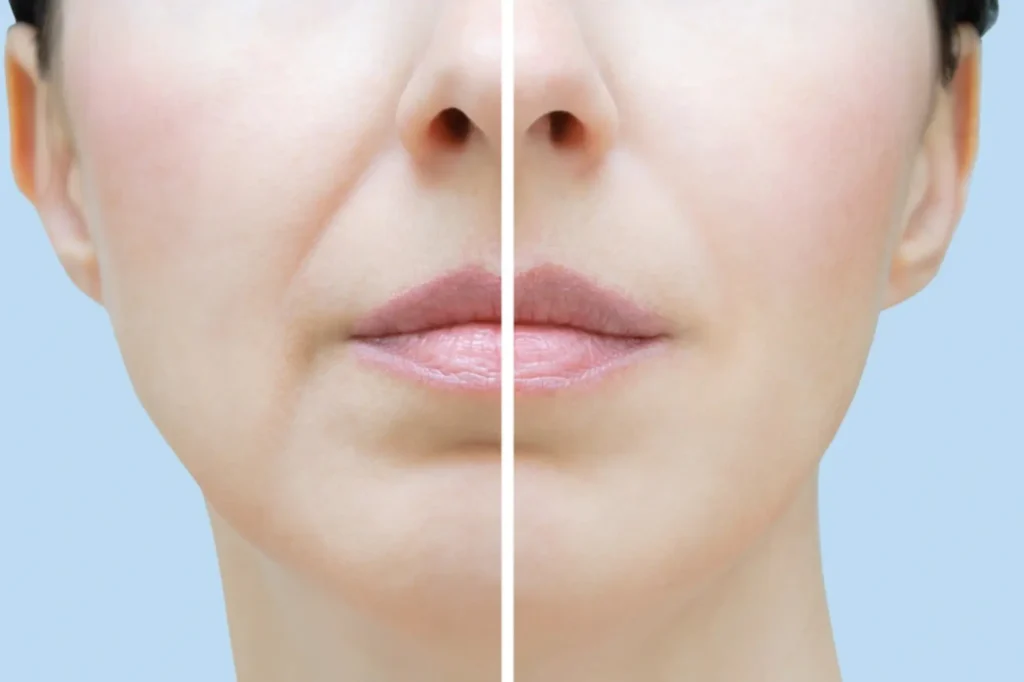 dermal fillers lahore