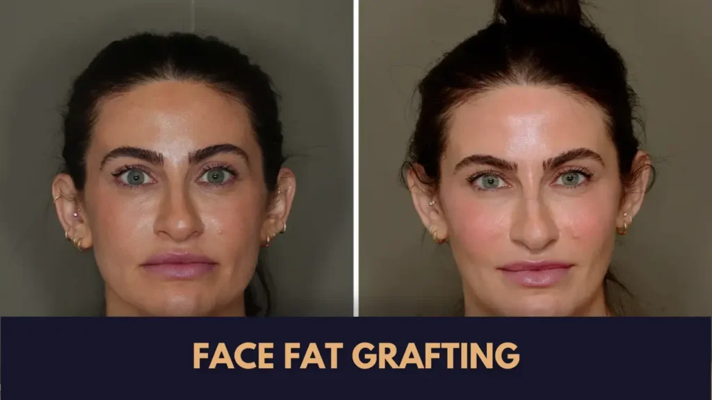 Face Fat Grafting Cost in Lahore before and after results by Dr Ammara Rabbani