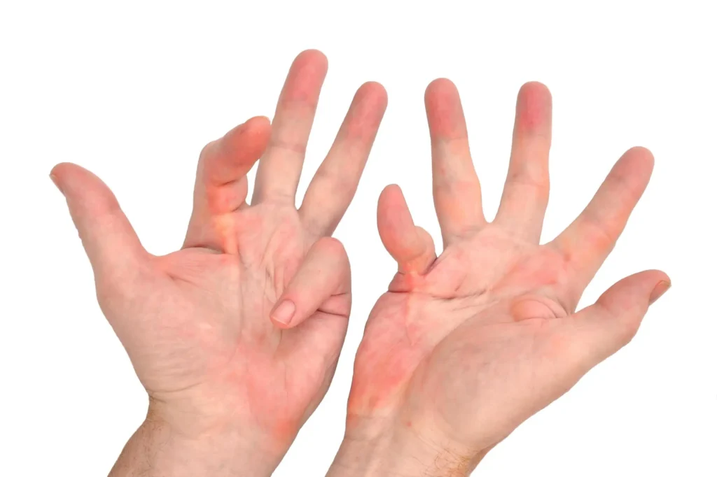 finger contracture treatment lahore