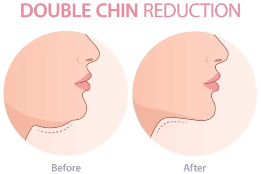 jawline surgery cost lahore
