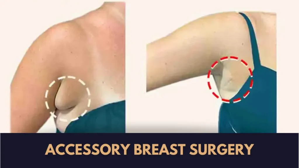 Accessory Breast Surgery in Lahore before and after by Dr Ammara Rabbani