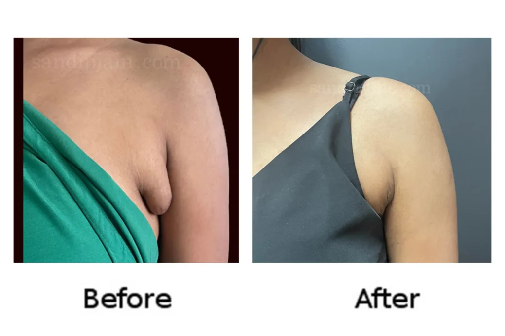 Smooth underarm contour after Accessory Breast Surgery in Lahore