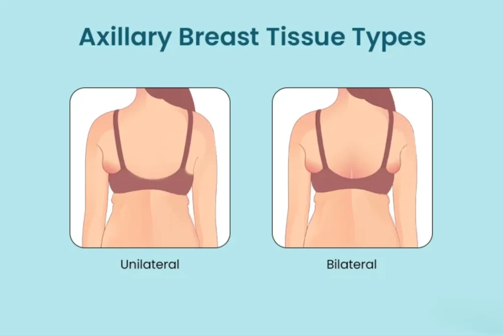 Accessory breast tissue in underarm showing axillary swelling in female patient