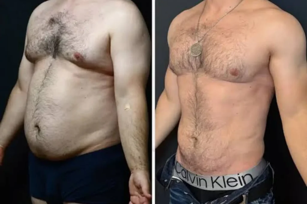 liposuction lahore