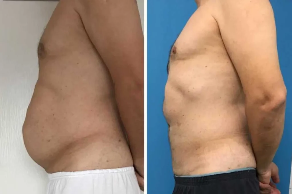 liposuction surgery lahore